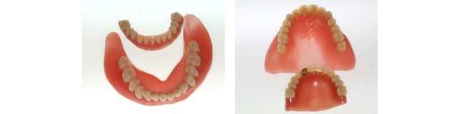 Pictured is a comparison of health insurance-covered dentures and dentures made using the maxillomandibular simultaneous impression method