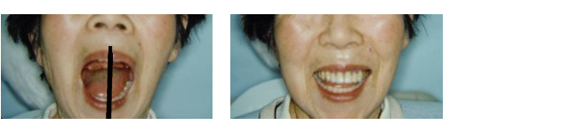 Cases of TMJ arthrosis caused by dentures