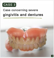 重度歯周病と入れ歯についての症例