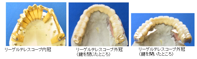 Dentures ideal for recovering chewing functions and protecting remaining teeth